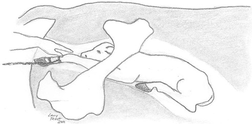 Side view drawing of a person’s arm entering the birth canal.