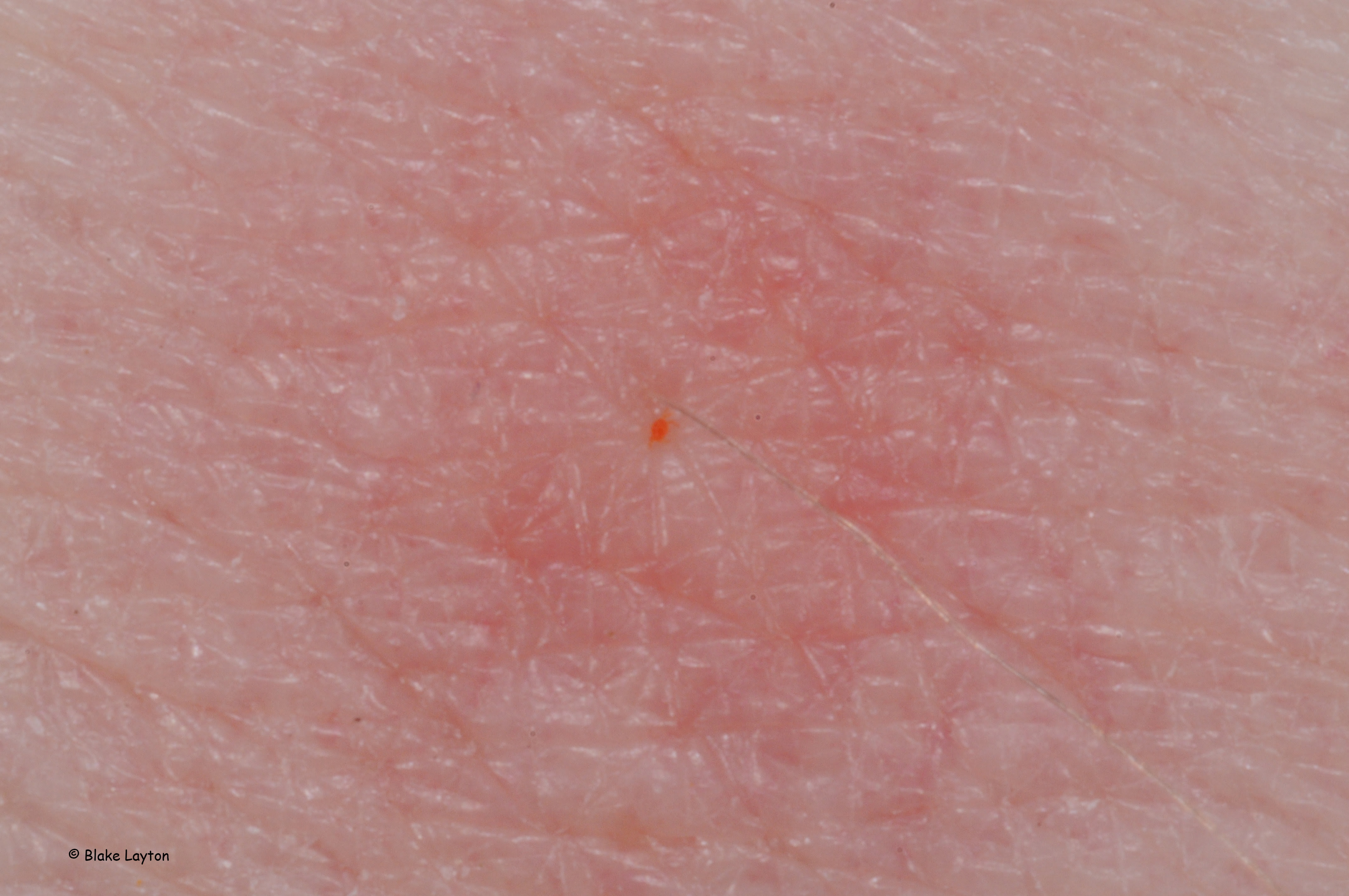 tiny pinpoint red dots on skin after sunburn