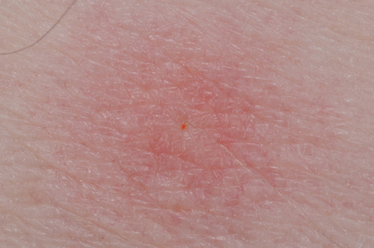 Close-up of a chigger bite showing the tiny orange chigger in the center of the welt.