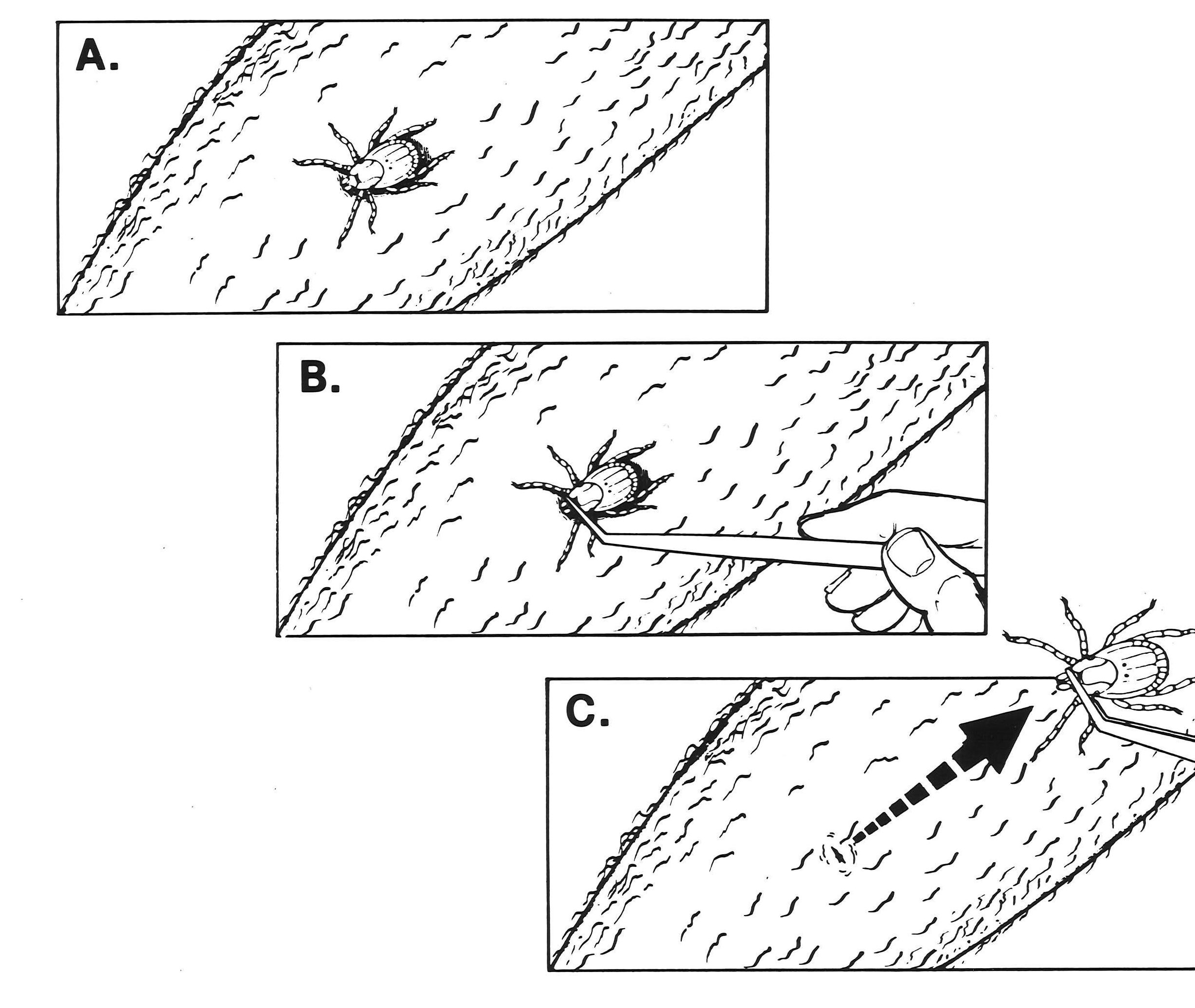 Diagram of removing a tick. A person grasps the tick right at the skin with tweezers and pulls it straight back to remove.