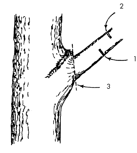 A damaged tree limb that requires the drop-cut removal technique described in the Broken and Torn Limbs section. 