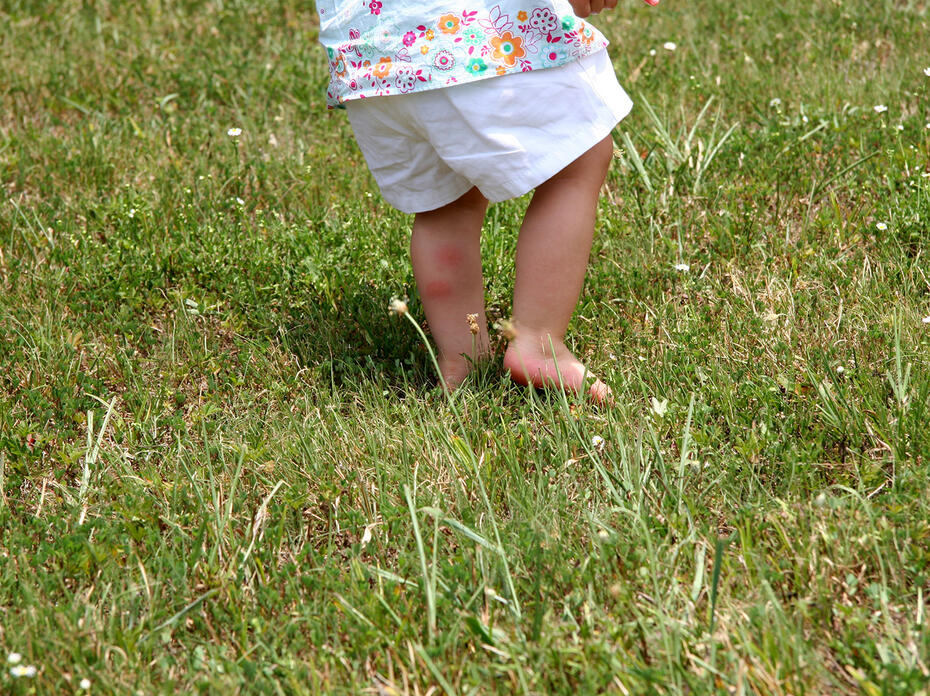 A small child runs barefoot through tall grass and has red insect bites on his calf. 