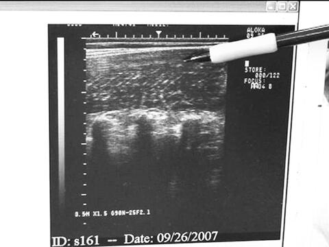 A mechanical pencil is pointed to an area of a scanned intramuscular fat image.