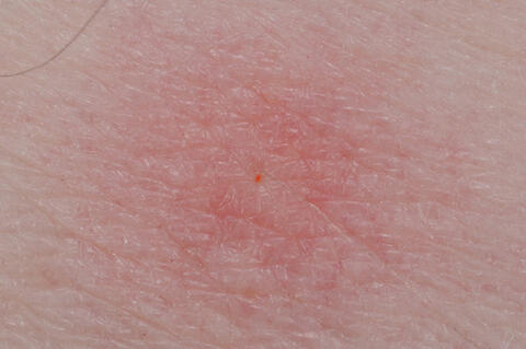 Close-up of a chigger bite showing the tiny orange chigger in the center of the welt.