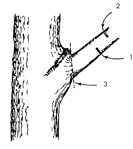 A damaged tree limb that requires the drop-cut removal technique described in the Broken and Torn Limbs section. 